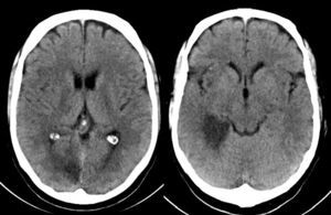 TC cerebral. Hipodensidad en territorio de ramas perforantes talámicas dorsolaterales y temporooccipital de la arteria cerebral posterior derecha.