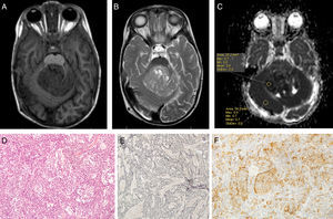 Imagen de tumor de alto grado (meduloblastoma) en A) T1 B) T2C) ADC D) Hematoxilina-eosina E) Reticulina F) Sinaptofisina.