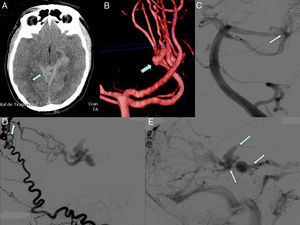 A) TAC craneal: hemorragia subaracnoidea en el comienzo del cuadro clínico. B) Reconstrucción 3D tomando como base la TAC: aneurisma de flujo en la arteria carótida superior izquierda. C) Embolización del anurisma. D) Arteriografía: aporte arterial de ramas meníngeas desde la arteria carótida externa; se ve el punto en el que la arteria occipital se hace intracraneal. E) Arteriografía: gruesas venas de drenaje con inversion del flujo que drenan en el seno recto.