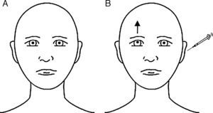 Esquema iconográfico que ilustra los hallazgos oculares de la paciente en la posición primaria de la mirada, antes de la instilación con gentamicina (A) y justo después de la aplicación de este tratamiento intraótico (B). En la situación basal, los globos oculares se encontraban en posición neutra. Después de completarse la LQG, la paciente presentó un desplazamiento superior del eje visual del ojo derecho, en tanto que el del ojo izquierdo se mantuvo inalterado (hipertropía; esta es la desalineación oculoaxial que se produce en la DS y que finalmente da lugar a la DVB). La DS suele ocasionarse por una alteración supranuclear del tronco del encéfalo o del cerebelo, afectando a las vías vestíbulo-oculares verticales o, a veces, al nervio vestibular o al órgano terminal vestibular (órgano de Corti). La DS usualmente, aunque no siempre, es comitante; cuando es incomitante, puede mimetizar una parálisis parcial de los nervios craneales tercero o cuarto. Habitualmente la etiología responde a una isquemia vascular de la protuberancia o del bulbo raquídeo lateral (síndrome de Wallenberg), presumiblemente debida al compromiso de los núcleos vestibulares o de sus proyecciones. Si el daño se localiza en la porción inferior de la protuberancia (como en el caso de la paciente que nos atañe), el ojo ipsilateral se encuentra más bajo (DS ipsiversiva), mientras que en las lesiones rostrales al nivel medio de la protuberancia, el más bajo es el ojo contralateral (DS contraversiva)1-3.