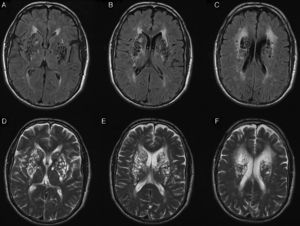Imágenes de resonancia magnética cerebral potenciadas en FLAIR (A-C) y T2 (D-F), con cortes axiales en los que se evidencian múltiples espacios perivasculares dilatados de predominio en región de los ganglios basales bilaterales.