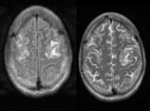 Secuencias de T1 con gadolinio en RM mostrando una lesión hipodensa en la corteza frontal izquierda sin captación de contraste.