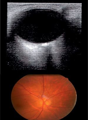 Superior: Ecografía modo A-B ojo derecho: imagen hiperecogénica en papila de nervio óptico con sombra acústica posterior de OD. Inferior: Drusas calcificadas en papila de nervio óptico de OD.