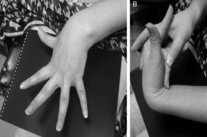 Paciente con Ehlers-Danlos tipo iii. A) Hiperextensión de los dedos y la muñeca. B) El dedo medio hipermóvil puede tocar el antebrazo.