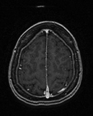 Hiperintensidad de señal en T1 (Ax FSE T1 + GD) de una vena cortical superior parietal izquierda, a la altura de la convexidad parasagital, compatible con trombosis venosa cortical.