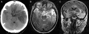 Afectación temporal, frontal basal, insular y cingular, de forma bilateral asimétrica con predominio izquierdo en imágenes de TC (A) y RM (corte axial potenciado en T2 [B] y coronal FLAIR [C]).
