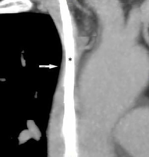 Tomografía computarizada de tórax con contraste, reconstrucción multiplanar. Se observa una ocupación de prácticamente toda la luz de la porción proximal de la vena cava superior (flecha) por parte del catéter (*).