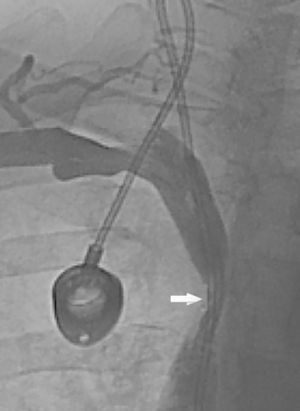 Cavografía. Se observa una leve estenosis de la porción proximal de la vena cava superior, complicada con un trombo en torno al catéter (flecha).