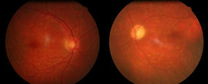 Fondo de ojo. Izquierda: fondo de ojo normal del ojo derecho. Derecha: atrofia de la papila del nervio óptico izquierdo con palidez del anillo neurorretiniano.