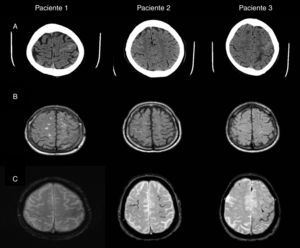 A) Imagen de TAC craneal: hiperintensidad en surco de la convexidad frontal correspondiente al sangrado subaracnoideo, frontal izquierdo en el paciente 1 y frontales derechos en los pacientes 2 y 3. B) Imagen de RM en secuencia FLAIR: hiperintensidad intrasurco a nivel del sangrado subaracnoideo visualizado en la TAC. C) Imagen de RM en secuencia ecogradiente: identifica la presencia de microbleeds y de la hemosiderosis superficial.