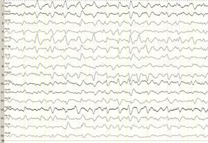 EEG de 16 canales de la paciente, que muestra enlentecimiento generalizado de la actividad de fondo con ondas trifásicas generalizadas durante todo el registro.
