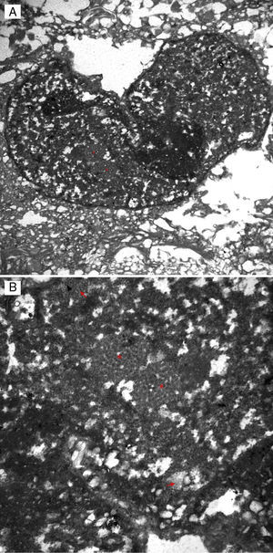 Imágenes por microscopio electrónico: A) Núcleo astrocitario con abundantes partículas virales en el nucleoplasma (mostrado con un asterisco). B) Aumento de la imagen previa que se focaliza en 2 inclusiones donde se muestran las cápsides virales (mostrado con asterisco).