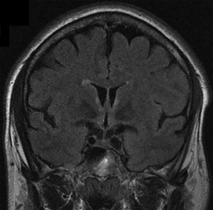 RMN cerebral (secuencia FLAIR coronal); hiperintensidad adyacente al III ventrículo y en cuerpos mamilares.
