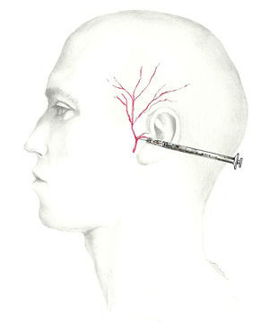 Abordaje del nervio auriculotemporal.