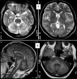 A) Estudio de RM-T2 en un paciente con SCA-ACM de 52 años: ausencia de lesiones de sustancia blanca y atrofia cortical; atrofia cerebelosa difusa. B) Estudio de RM-T1 en un paciente con SCA-ACM de 86 años: patrón de atrofia olivopontocerebelosa.