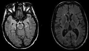 Resonancia magnética cerebral en secuencia FLAIR, que muestra lesiones hiperintensas leves en ambos brazos posteriores de cápsula interna, y más evidentes en región anterolateral de protuberancia.