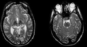 Resonancia magnética cerebral secuencia T2, que muestra lesión hiperintensa en ambos tractos piramidales a nivel de protuberancia y lesiones hipointensas a nivel mesencefálico en núcleo rojo y sustancia negra.