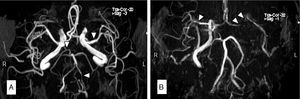 La angiografía por resonancia magnética (a-RM) del paciente 1 (A) mostró una oclusión de la arteria vertebral (AV) izquierda y aterosclerosis difusa intracraneal, especialmente en la AV derecha, la arteria cerebral media (ACM) izquierda y la arteria cerebral posterior (ACP) derecha. La a-RM del paciente 2 (B) mostró una ausencia de flujo en la arteria carótida interna (ACI) izquierda y la ACM izquierda, con aterosclerosis intracraneal de predominio en la ACM derecha y la ACP derecha.