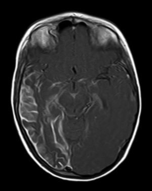 Resonancia magnética craneal en secuencia T1 con contraste que muestra angiomatosis leptomeníngea con atrofia secundaria en la región temporooccipital derecha.