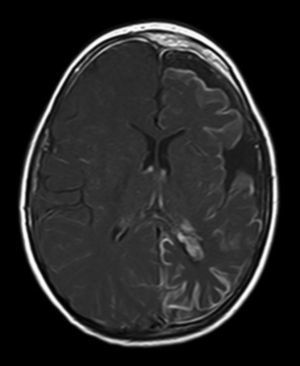 Resonancia magnética craneal T1 con contraste que muestra angiomatosis leptomeníngea con atrofia del hemisferio cerebral izquierdo.