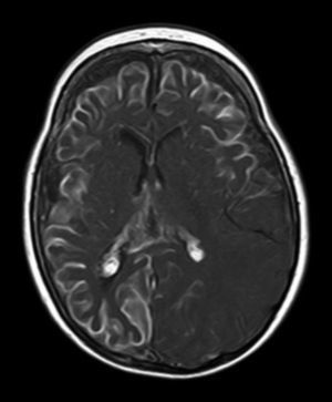 Resonancia magnética craneal T1 con contraste que muestra angiomatosis leptomeníngea bilateral.