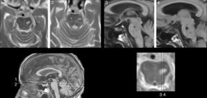 Mujer de 81 años con hipoacusia, diabetes y dislipidemia, que desde los 78 años tiene alucinaciones auditivas complejas verbales y musicales. En la exploración se aprecia parálisis de la mirada hacia arriba. Las imágenes de resonancia muestran una lesión situada en la parte anterior del lemnisco lateral, en la confluencia pontomesencefálica izquierda (1 y 2: secuencias TSE-T2; 3 y 4: secuencias SE-T1).