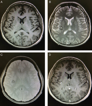 Imagen por resonancia magnética de cráneo, realizada 24h después de su admisión al hospital. A) Imagen en secuencia T1 sin contraste, que muestra una pequeña lesión, bien circunscrita, en la ínsula derecha con hiperintensidad de señal. B) Imagen en secuencia T2 que revela hiperintensidad de señal heterogénea con anillo hipointenso que respeta la sustancia gris. C) Imagen en secuencia T1 con gadolinio, que demuestra realce homogéneo. D) Echo de gradiente que demuestra una lesión en la ínsula derecha con anillo oscuro en su periferia (hemosiderina), patrón en «palomita de maíz».