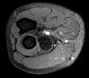 Resonancia magnética de extremidad superior derecha 1,5T, imagen en STIR, corte axial: tumoración hipointensa que es sugestiva de lipoma.