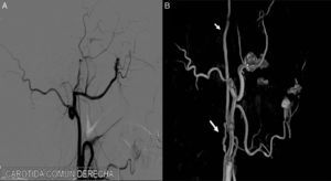A) Angiografía de troncos supraaórticos en la que se ve una oclusión de arteria carótida interna derecha. B) Angiografía de troncos supraaórticos en la que se ve que la ACI derecha ocluida se ha recanalizado.