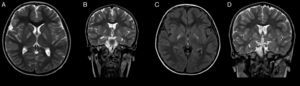 Cortes de RM en los que se visualizan hiperintensidad de núcleos pálidos de forma bilateral. A) Corte axial T2; B) Corte coronal T2; C) Corte axial FLAIR a los 2 meses de A y B, y D) Corte coronal T2 (2 meses después de A y B).
