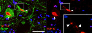 Imágenes en las que se observa que los animales tratados con cELA-LCR mostraron inclusiones citoplasmáticas de TDP-43 en las neuronas de la médula espinal (flechas). En el detalle se observan las inclusiones (cabezas de flecha). Escala: 40μm.