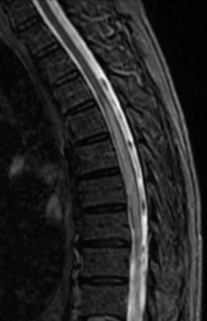 RM cervicodorsal STIR-sagital: aumento de volumen y de señal en médula dorsal desde D4 a D8 de predominio anterior, compatible con mielitis.