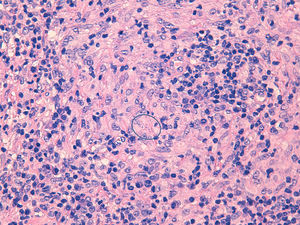 Biopsia de la lesión cutánea con tinción hematoxilina eosina que revela un infiltrado inflamatorio linfoplasmocitario con granulomas no caseificantes y amastigotes (círculo).