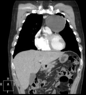 TC de tórax. Masa en el mediastino anterior indicativa de quiste tímico.