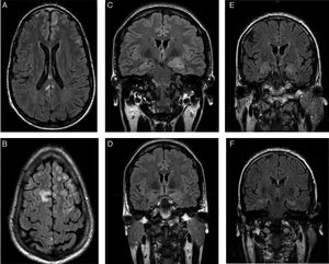 A y B) RM cerebral del primer caso (FLAIR), que mostró lesiones subcentrimétricas frontales bilaterales y una lesión hiperintensa en T2 en parte posterior del cuerpo calloso sin captación de contraste. C y D) RM cerebral diagnóstica y de control del segundo caso (FLAIR), que evidenció un aumento de tamaño y señal en amígdala y cabeza de hipocampo izquierdo, y posterior disminución de su tamaño y señal. E y F) RM cerebral diagnóstica del tercer caso (FLAIR), que mostró un aumento de señal en ambos hipocampos.