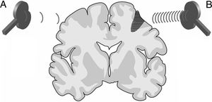 Imagen representativa de un corte coronal de un cerebro humano. Modalidades de EMTr para fomentar la NP y, por ende, la neurorrehabilitación más precoz del paciente con un ictus. EMTr a baja frecuencia (≤ 1Hz) en el hemisferio cerebral sano, contralateral a una lesión vascular corticosubcortical (zona sombreada más oscura con rayas horizontales), para disminuir la inhibición recíproca ejercida sobre el hemisferio afecto (A). EMTr a alta frecuencia (≥ 5Hz) en el hemisferio ipsolateral a la lesión, para estimular la actividad neuronal y favorecer la reorganización de las redes interneuronales (B).Adaptada con permiso de Edwardson et al., 20137.