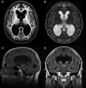 Resonancia magnética preoperatoria de un paciente diagnosticado de hidrocefalia crónica del adulto idiopática con buena respuesta tras la implantación de una derivación ventrículo-peritoneal. A) Corte axial potenciado en T1. Moderada dilatación de los ventrículos laterales y del tercer ventrículo. B) Corte axial potenciado en T2. Artefactos de señal por vacío de flujo en el tercer ventrículo y ausencia de hiperintensidades de señal tanto a nivel periventricular como subcortical. C) Corte sagital potenciado en T1. Descenso del suelo y abalonamiento del tercer ventrículo, con reducción de la distancia mamilo-pontina. El acueducto de Silvio se encuentra permeable, sin que se visualicen causas obstructivas que justifiquen la dilatación ventricular. D) Corte coronal FLAIR. Patrón típico de borramiento de surcos en la convexidad alta del cerebro, especialmente en la línea media. El artefacto por vacío de flujo que se objetivaba en la secuencia T2 se extiende hacia ambos agujeros de Monro, alcanzando la porción inferior y medial de los cuerpos ventriculares. Ausencia de hiperintensidades de señal periventriculares y subcorticales.
