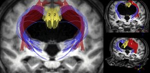 Reconstrucción tractográfica de las secuencias de tensor de difusión (DTI) del paciente mostrado en la figura 1, en la que puede observarse la distorsión generada por la dilatación ventricular en el trayecto del tracto piramidal (1) y en las conexiones córtico-estriadas y córtico-reticulares (3). Estos últimos tractos se encuentran adelgazados de una forma bastante acusada, al igual que ocurre con el fascículo cingulado (2) y, en menor medida, con el tracto piramidal (1).