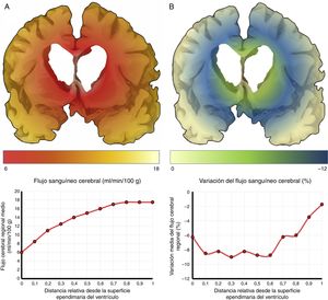 Flujo sanguíneo cerebral (FSC) de la región periventricular en la hidrocefalia crónica del adulto idiopática. A) Relación entre el FSC y la distancia desde la superficie ependimaria del ventrículo, mostrando una curva de tipo logaritmo18. B) Cuando se produce una sobrecarga volumétrica, el FSC cae en la zona de última pradera subependimaria, situada entre 5 y 15mm de la superficie ventricular.