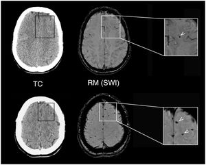 Hallazgos neurorradiológicos en un paciente de 26 años que presentó un traumatismo craneoencefálico leve. La tomografía computarizada (TC) cerebral, practicada a las 2 h del traumatismo, fue normal (izquierda), mientras que la resonancia magnética (RM) craneal (derecha) practicada a los 10 días objetivó focos de alteración de la señal en la secuencia Susceptibility Weighted Imaging (SWI) (flechas), correspondientes a microsangrados indicativos de lesión axonal difusa leve.