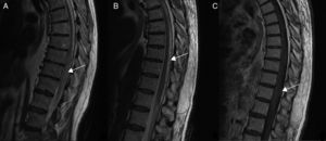 Características radiológicas típicas de las FAVE en RM. A) Hiperseñal medular en secuencia T2 correspondiente a edema. B) Flow voids característicos de la congestión venosa. C) Vasos serpinginosos tras la administración de contraste.