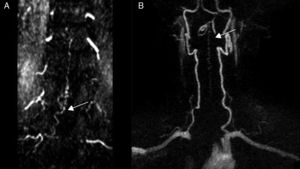 Secuencias TRICKS de RM que muestran la localización exacta del nivel de la fístula. A) FAVE dural L2 derecha (paciente 10). B) FAVE dural C1 (paciente 3).