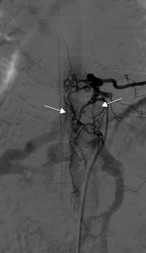 Arteriografía espinal del paciente 6 que demuestra fístula epidural lumbar bilateral.