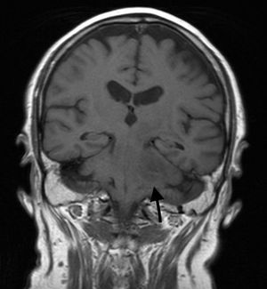 Imagen de la resonancia magnética cerebral, T1 coronal. Se observa el origen protuberencial de la lesión.