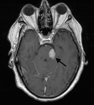 Imagen de la resonancia magnética cerebral, T1 axial con gadolinio.