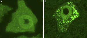 Se muestran 2 MN de un ratón control sano (A) y de un modelo de ratón transgénico de ELA (modelo SOD1G93A) teñidas con ubiquitina. Puede observarse cómo en el ratón sano no se observan inclusiones citoplasmáticas, mientras que el ratón transgénico (B) presenta múltiples agregados poliubiquitilados secundarios al colapso proteasomal.