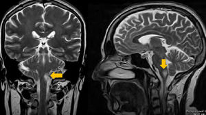 Cortes coronal y sagital de la RM secuencia T2, en los que se observa infarto laterobulbar izquierdo (flechas).