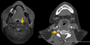 La imagen de la izquierda corresponde a un corte a nivel cervical en secuencia T1 de la RMN, y en la que se observa una oclusión de la arterial vertebral izquierda con la arteria vertebral derecha permeable. La imagen de la derecha corresponde a un corte a nivel cervical de la angio-TC realizada en el segundo ingreso, en el que se observa una disección de la arteria vertebral derecha, mientras que la arteria vertebral izquierda aparece recanalizada.
