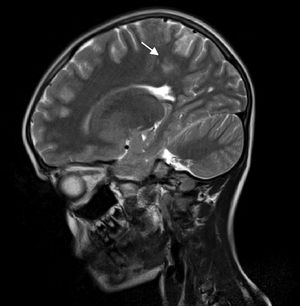 Resonancia magnética cerebral, sagital, T2. Se observan áreas hiperintensas córtico-subcortical témporo-parietal (flecha).
