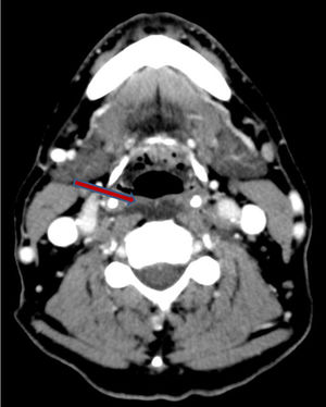 Imagen axial de la TC de cuello con CIV, donde se identifica colección prevertebral, sin realce periférico asociado.